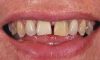 Zobne luske v estetskem zobozdravstvu